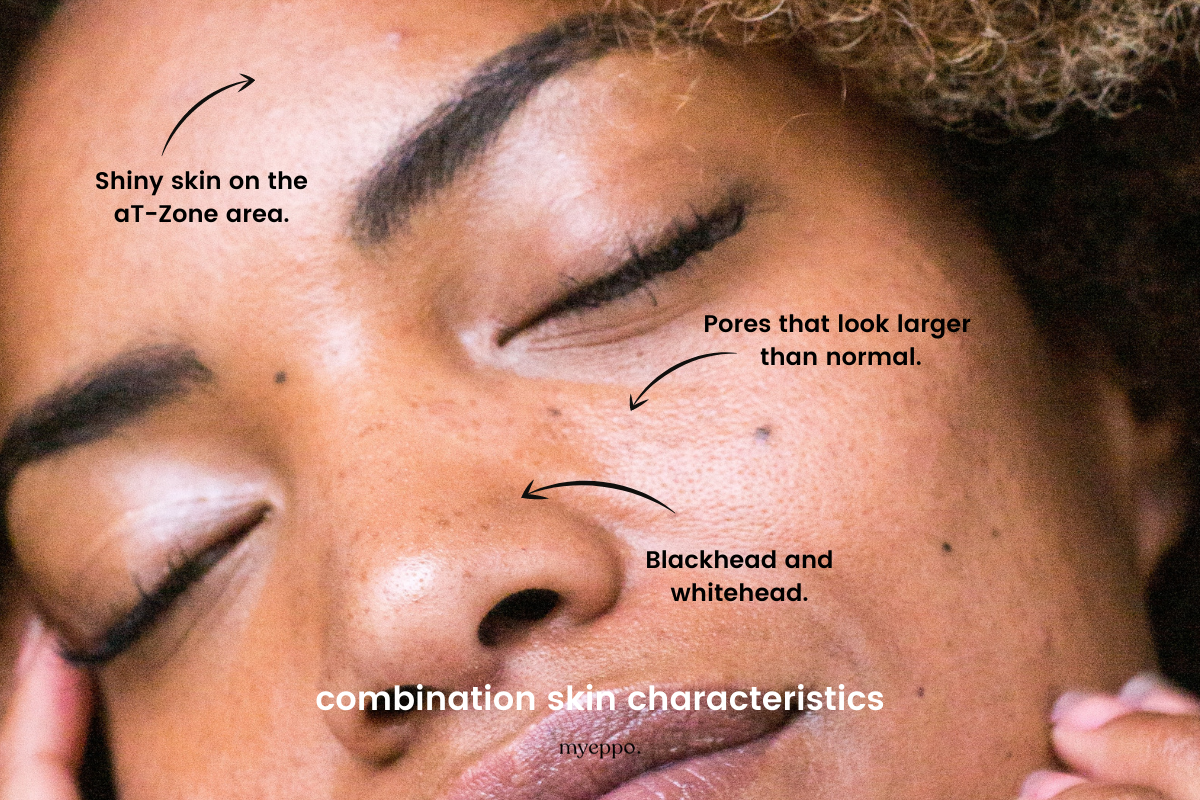 Combination Skin Characteristics Myeppo 