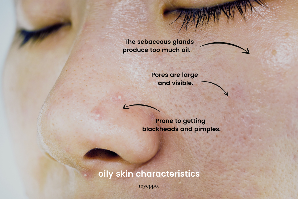 oily skin characteristics myeppo