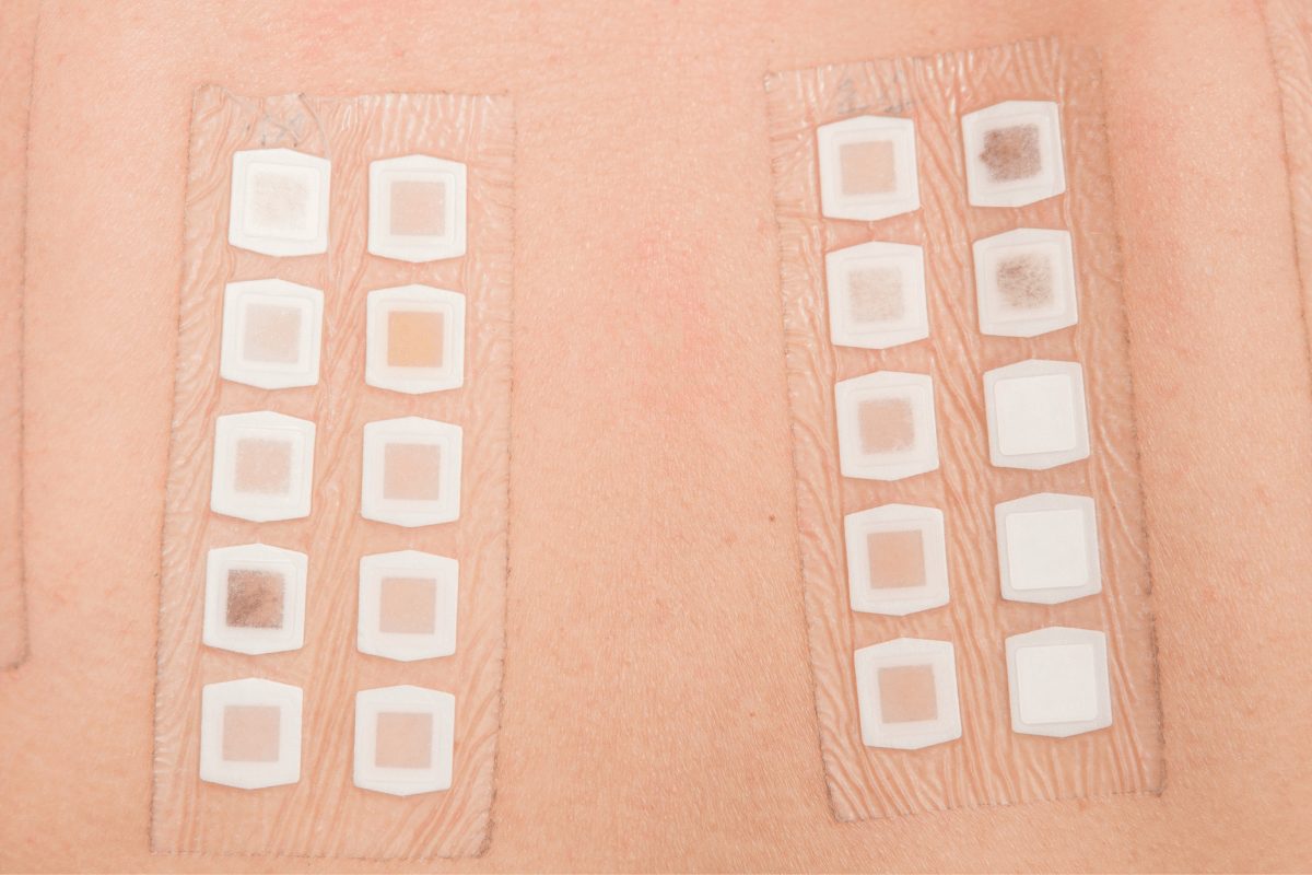 how to do a patch test at home dr ingky myeppo blog