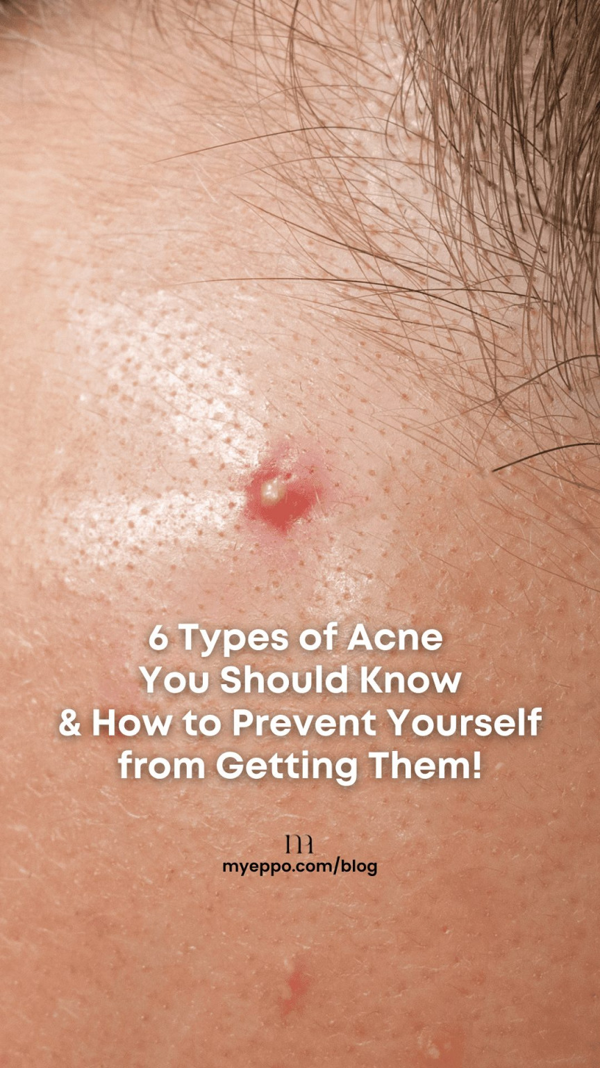 6 Types of Acne You Should Know and How to Prevent Yourself from ...