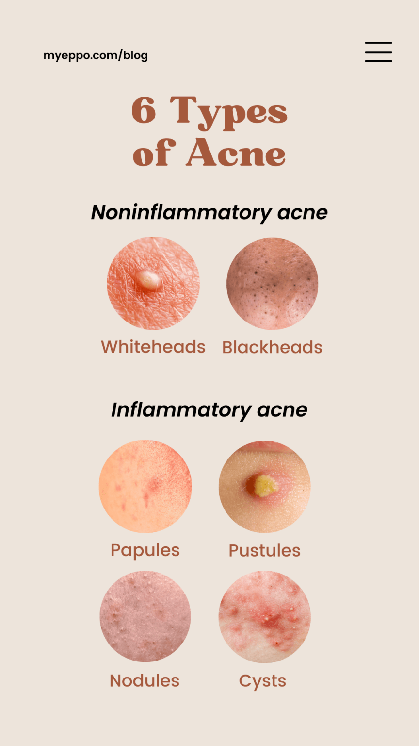 6 Types of Acne You Should Know and How to Prevent Yourself from ...