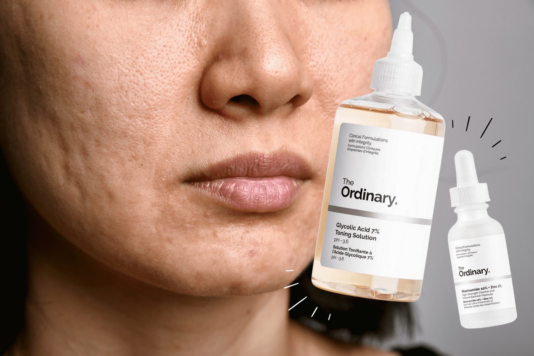 the ordinary products for acne scars myeppo