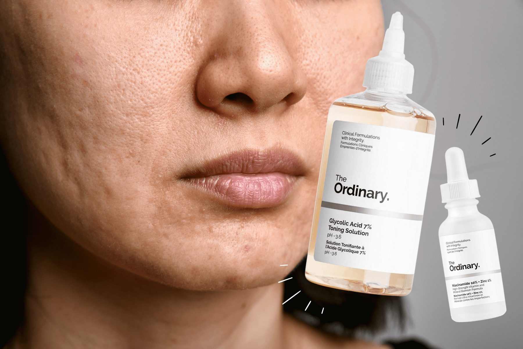  ralok Prsia Nede a The Ordinary Acne Scars Poter Shipley Metodol gie