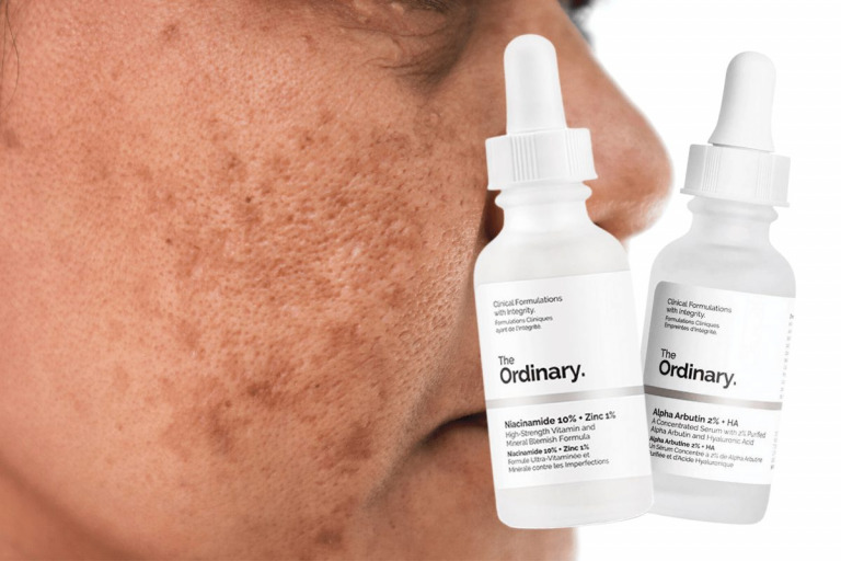 Treating Dark Spots with Alpha Arbutin and Niacinamide myeppo.