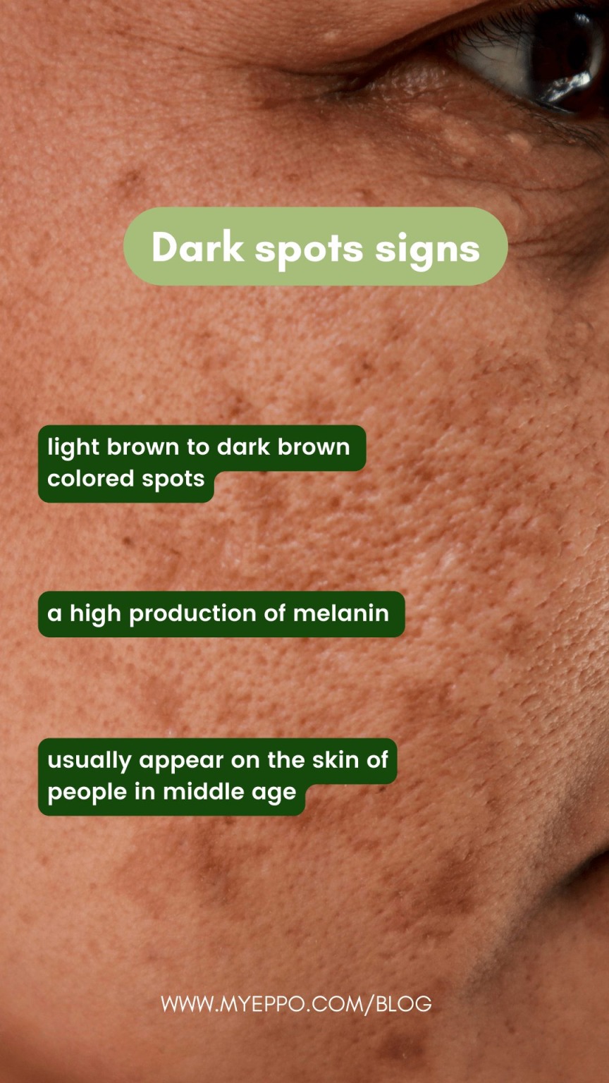 Treating Dark Spots with Alpha Arbutin and Niacinamide myeppo.